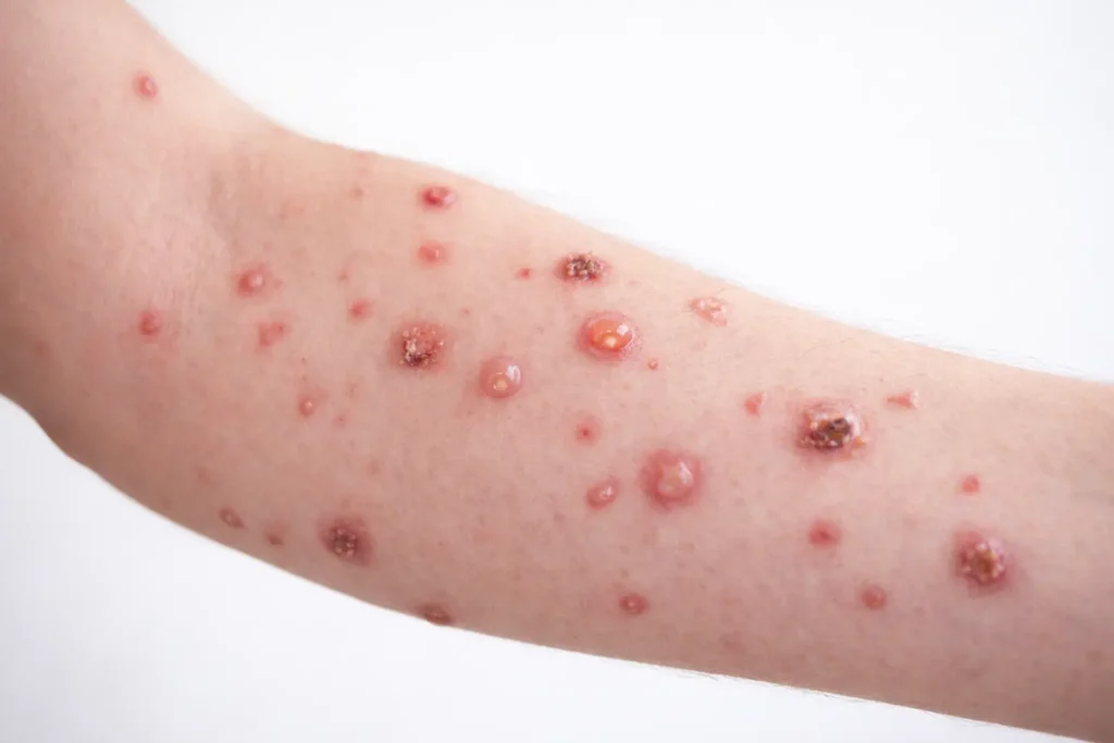 চিকেন পক্স বা জল বসন্ত রোগের লক্ষণ, চিকিৎসা ও করণীয় কি জেনে নিন