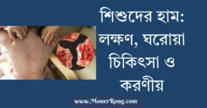 শিশুদের হাম হলে কি করনীয়