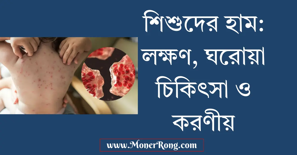 শিশুদের হাম হলে কি করনীয়